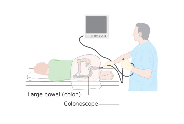 L’impacte de la COVID-19 en el càncer colorectal