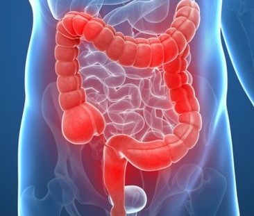 What is intestinal or colon cancer and how to detect it on time?